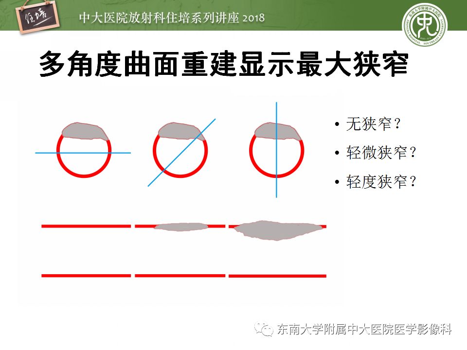 【PPT】冠脉CTA阅片要点及标准化报告
