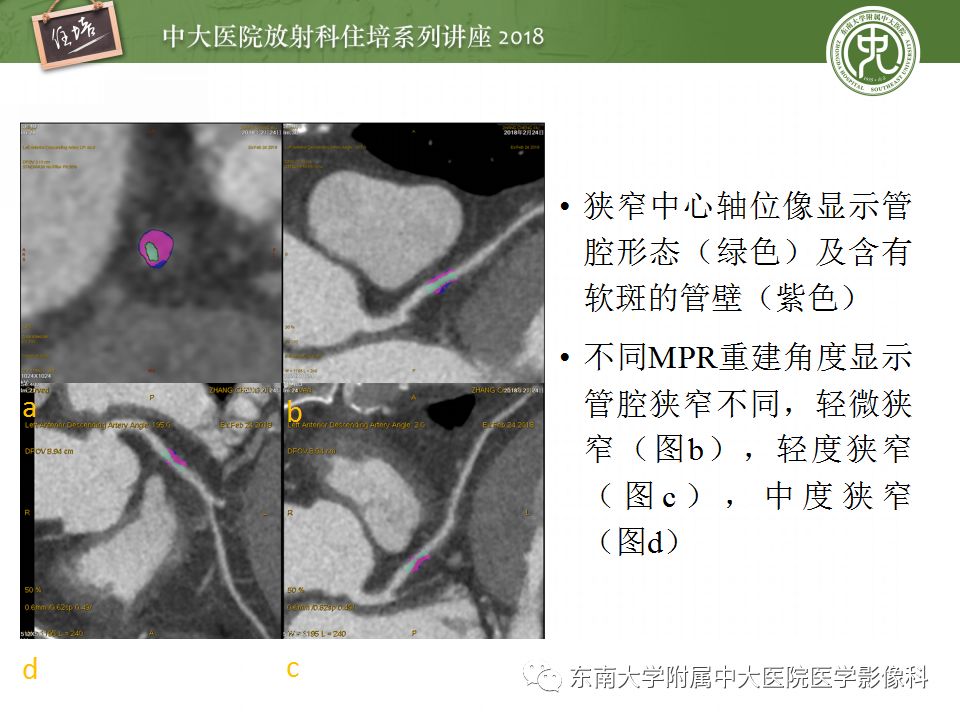 【PPT】冠脉CTA阅片要点及标准化报告