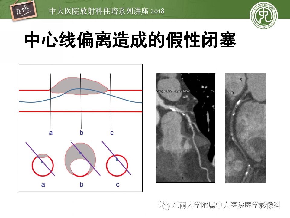 【PPT】冠脉CTA阅片要点及标准化报告