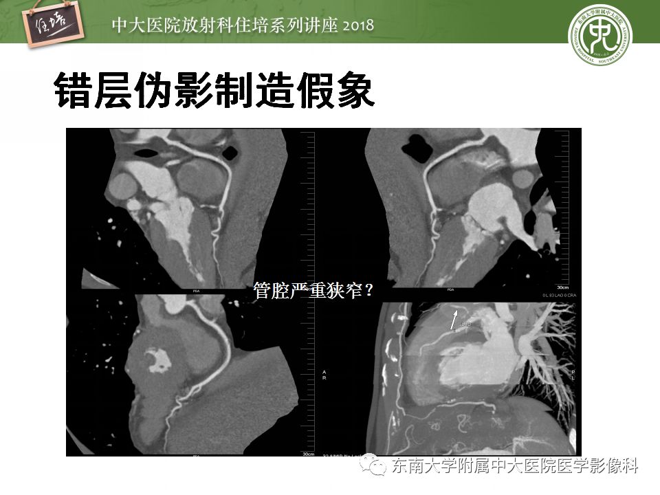 【PPT】冠脉CTA阅片要点及标准化报告