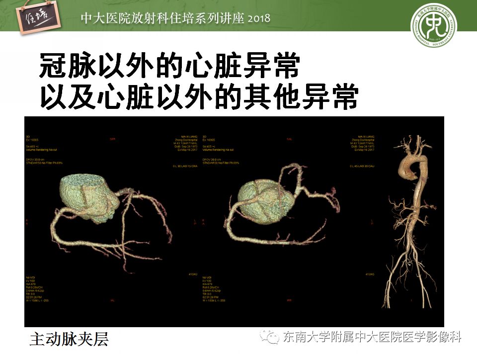 【PPT】冠脉CTA阅片要点及标准化报告