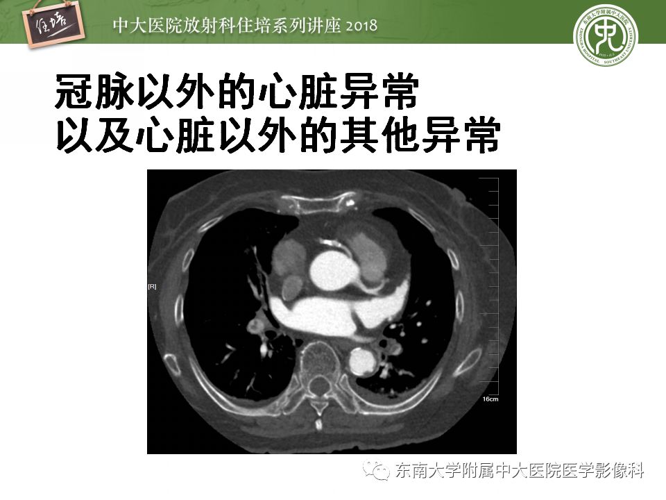 【PPT】冠脉CTA阅片要点及标准化报告