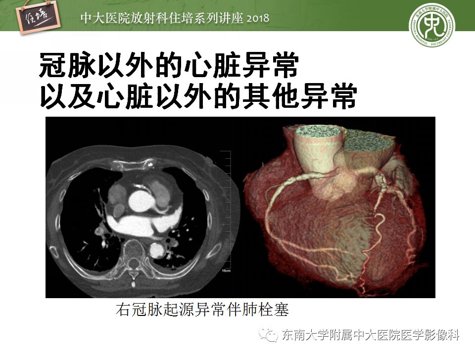 【PPT】冠脉CTA阅片要点及标准化报告