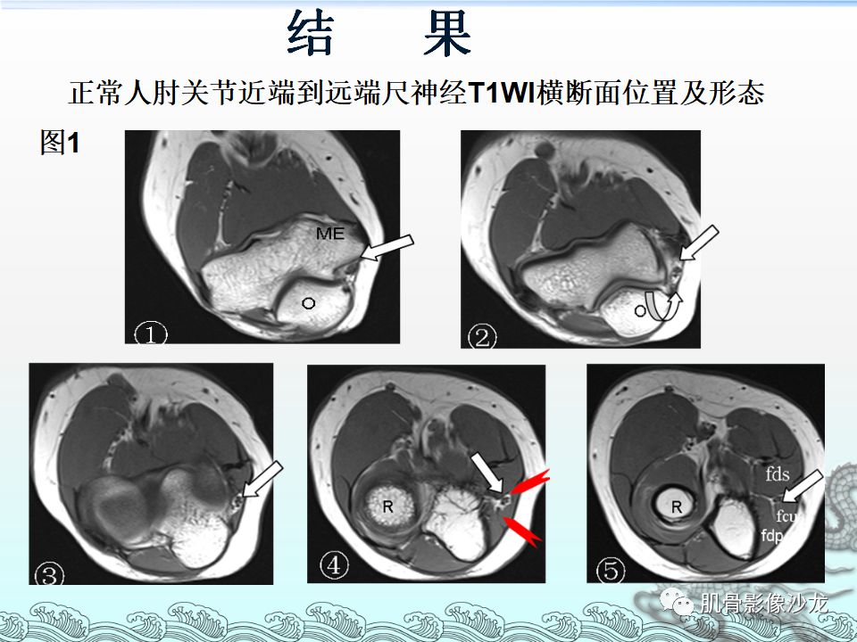 【PPT】肘管的磁共振应用研究