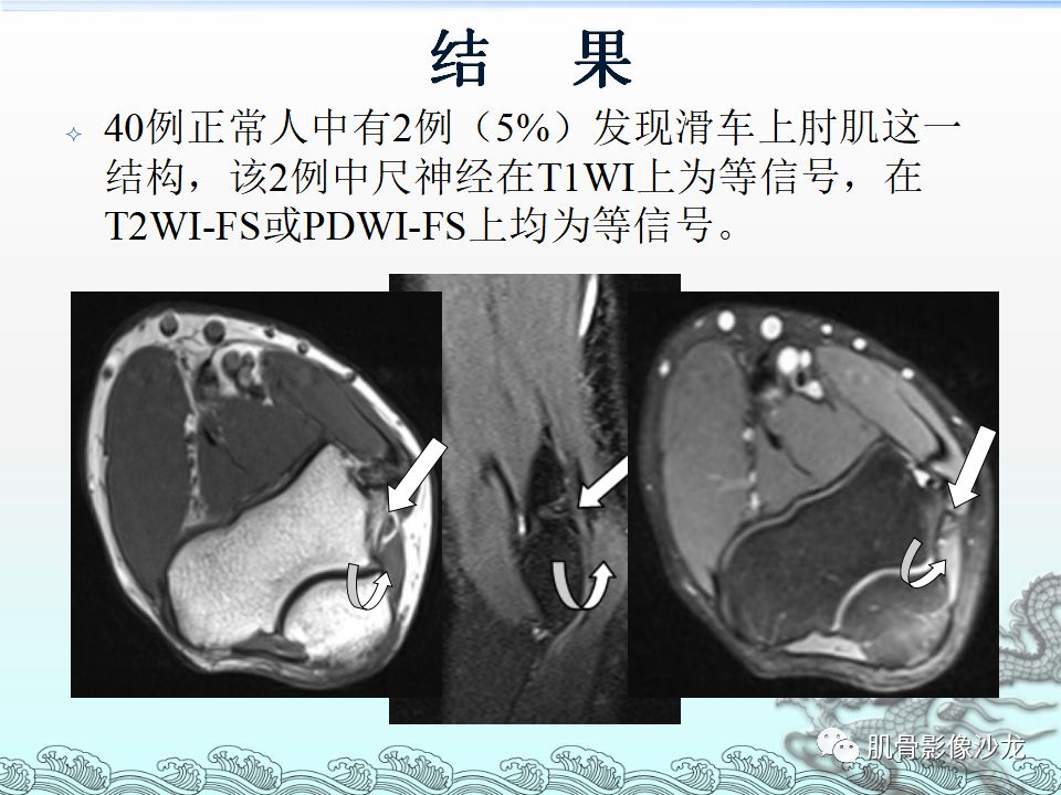 【PPT】肘管的磁共振应用研究