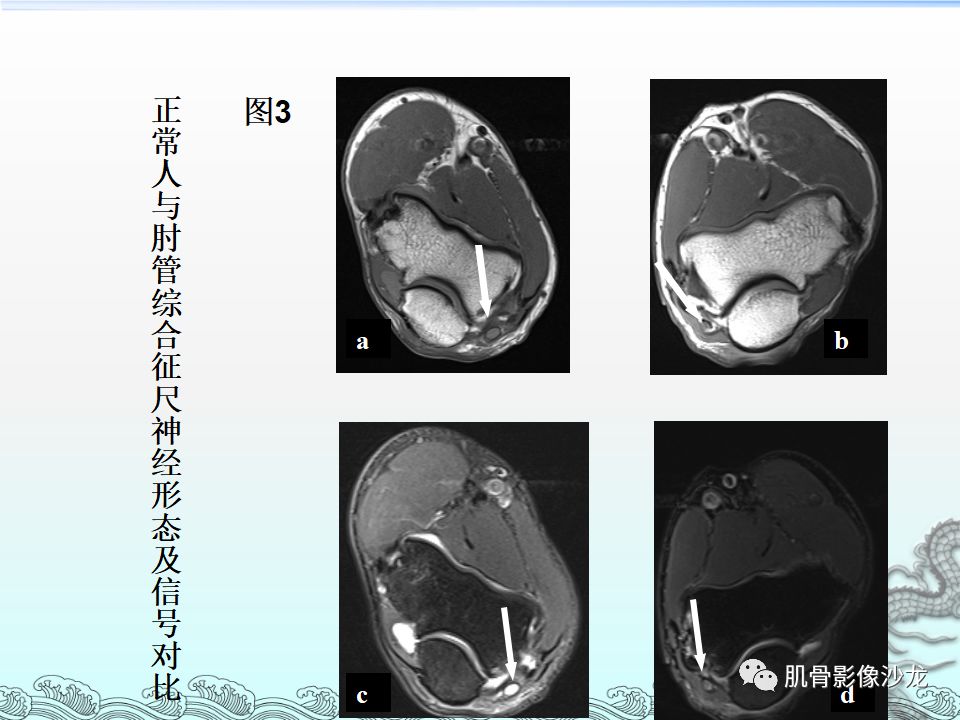 【PPT】肘管的磁共振应用研究