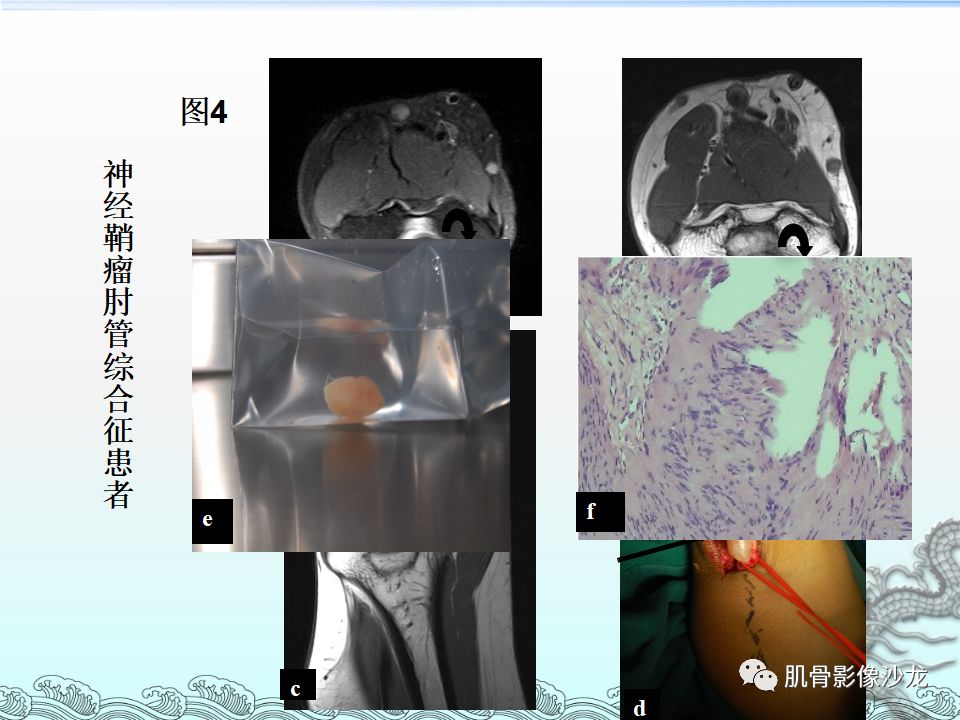 【PPT】肘管的磁共振应用研究