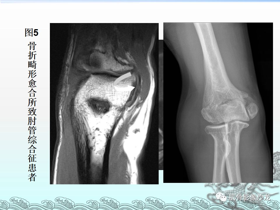 【PPT】肘管的磁共振应用研究