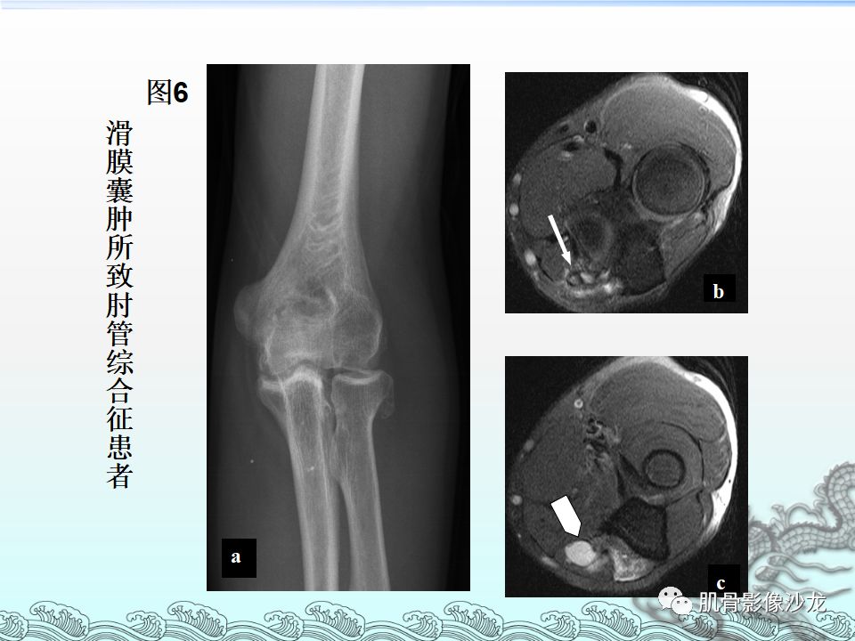 【PPT】肘管的磁共振应用研究