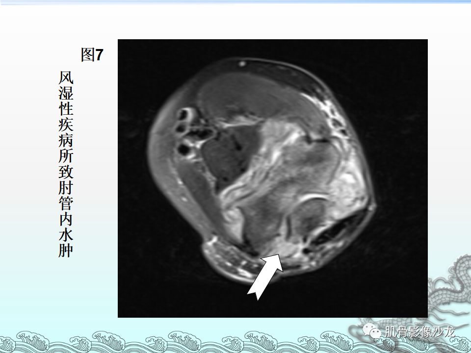 【PPT】肘管的磁共振应用研究