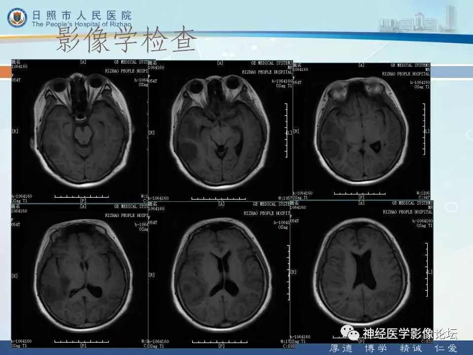 【病例】罕见颅内恶性外周神经鞘瘤一例MR