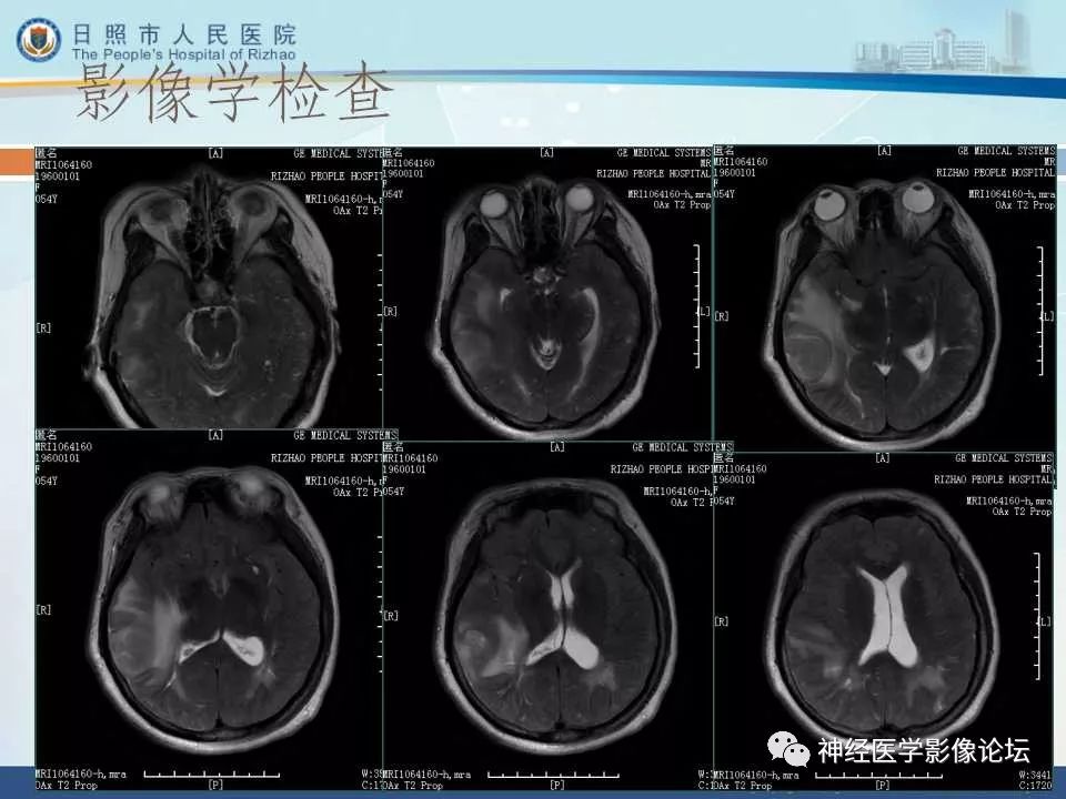 【病例】罕见颅内恶性外周神经鞘瘤一例MR