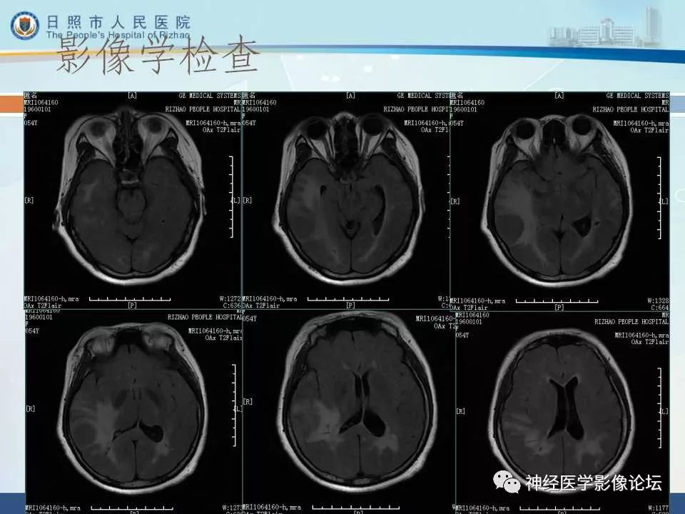 【病例】罕见颅内恶性外周神经鞘瘤一例MR