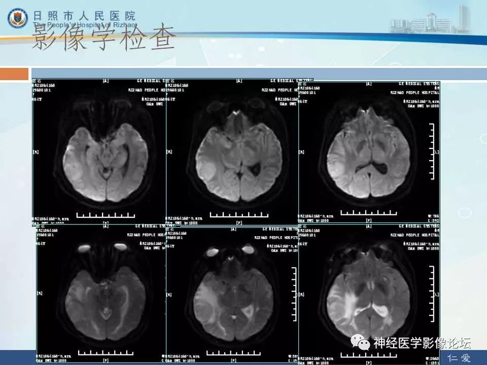 【病例】罕见颅内恶性外周神经鞘瘤一例MR