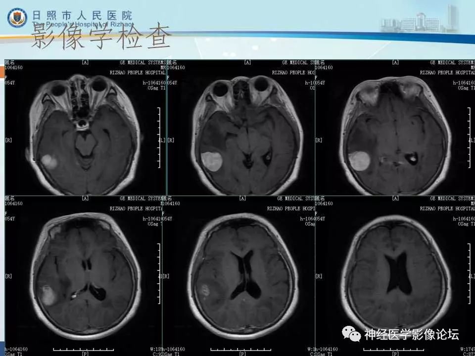 【病例】罕见颅内恶性外周神经鞘瘤一例MR