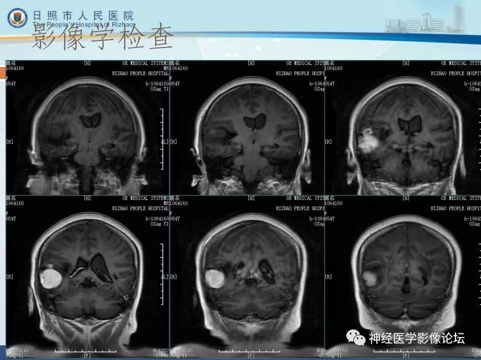 【病例】罕见颅内恶性外周神经鞘瘤一例MR