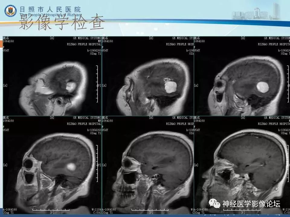 【病例】罕见颅内恶性外周神经鞘瘤一例MR
