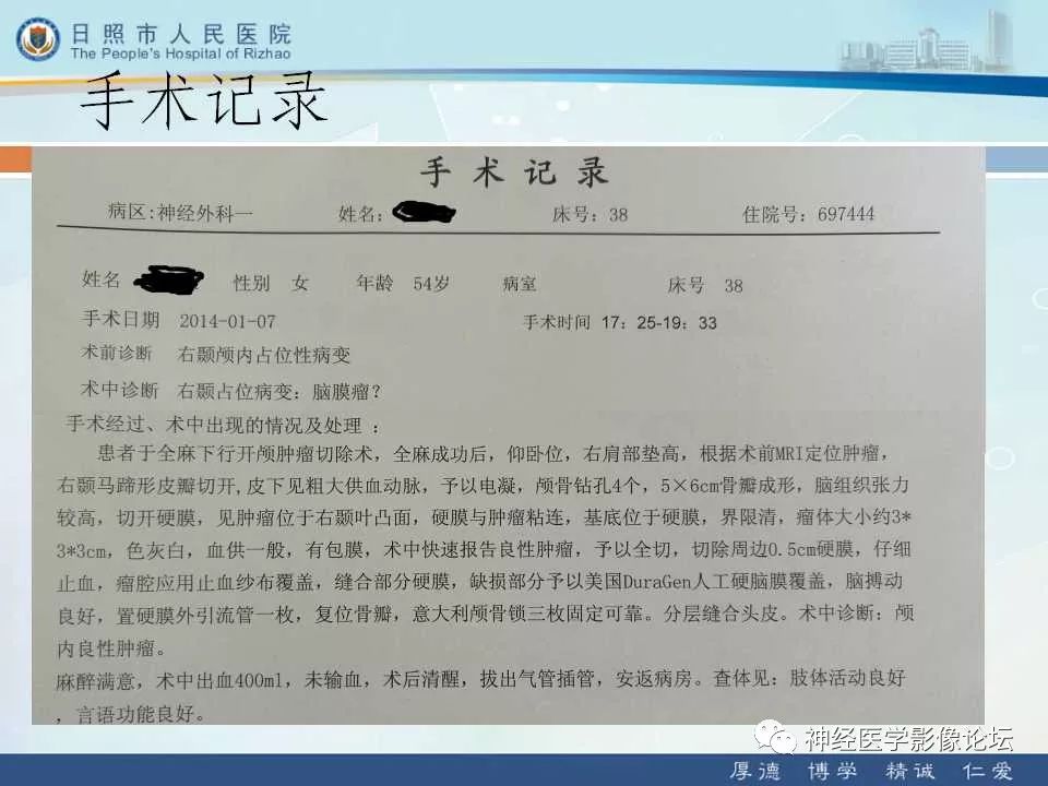 【病例】罕见颅内恶性外周神经鞘瘤一例MR