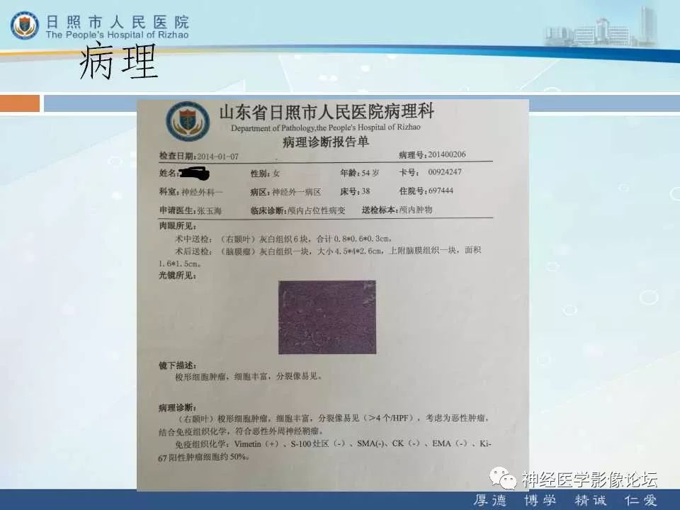 【病例】罕见颅内恶性外周神经鞘瘤一例MR