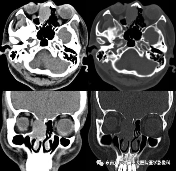 【病例】鼻腔鼻窦横纹肌肉瘤1例CT及MR影像表现
