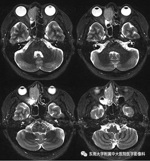 【病例】鼻腔鼻窦横纹肌肉瘤1例CT及MR影像表现