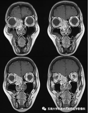 【病例】鼻腔鼻窦横纹肌肉瘤1例CT及MR影像表现