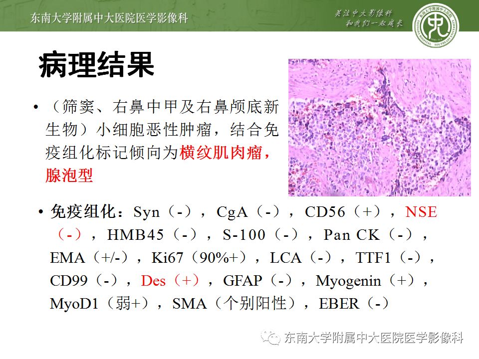 【病例】鼻腔鼻窦横纹肌肉瘤1例CT及MR影像表现