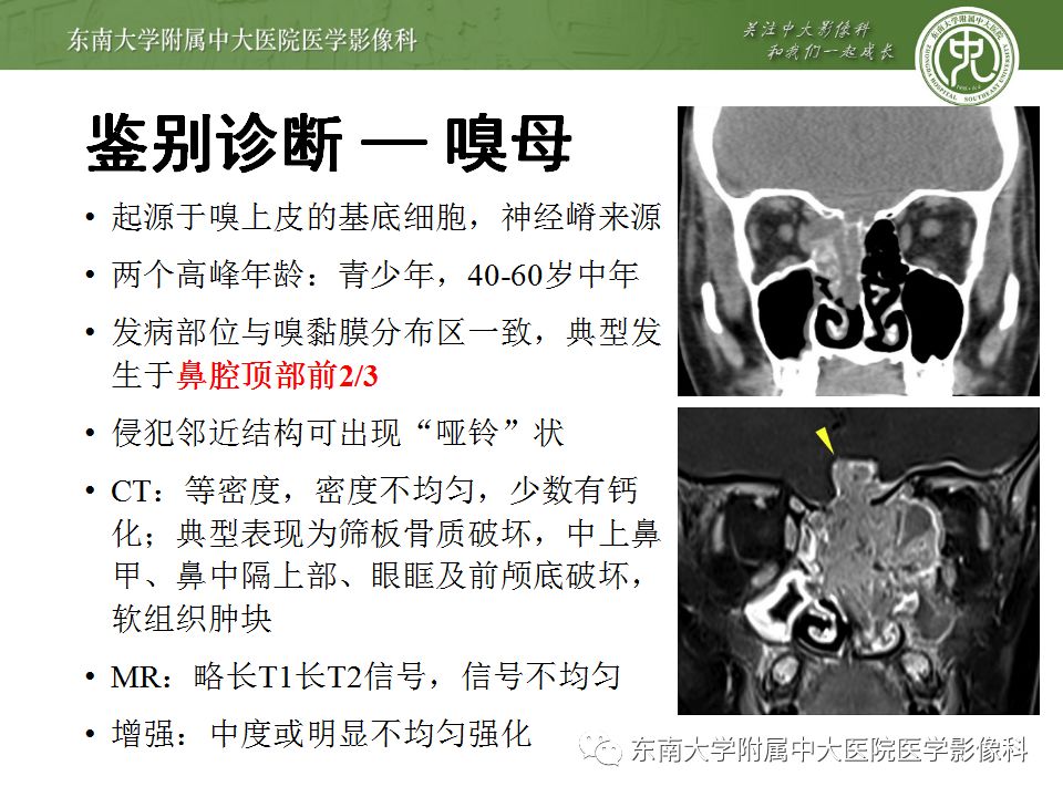 【病例】鼻腔鼻窦横纹肌肉瘤1例CT及MR影像表现