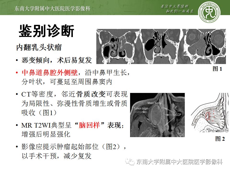 【病例】鼻腔鼻窦横纹肌肉瘤1例CT及MR影像表现