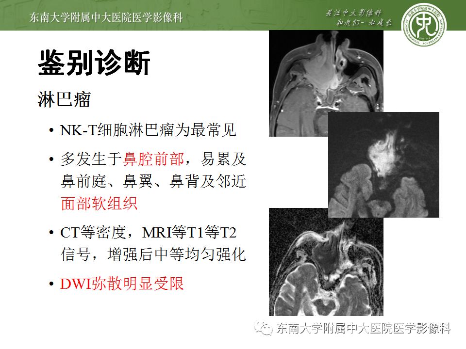 【病例】鼻腔鼻窦横纹肌肉瘤1例CT及MR影像表现