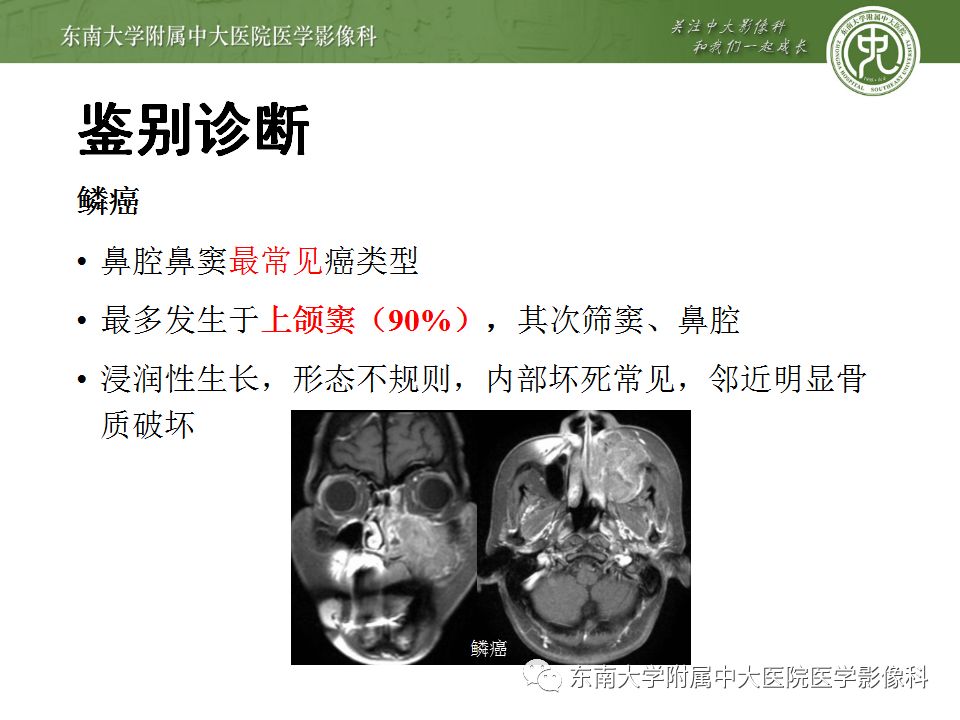 【病例】鼻腔鼻窦横纹肌肉瘤1例CT及MR影像表现