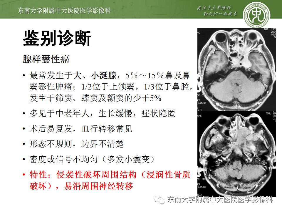 【病例】鼻腔鼻窦横纹肌肉瘤1例CT及MR影像表现
