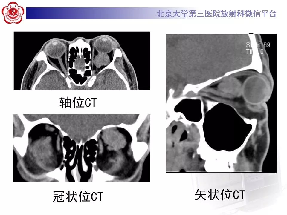【病例】眼眶海绵状血管瘤1例CT及MR