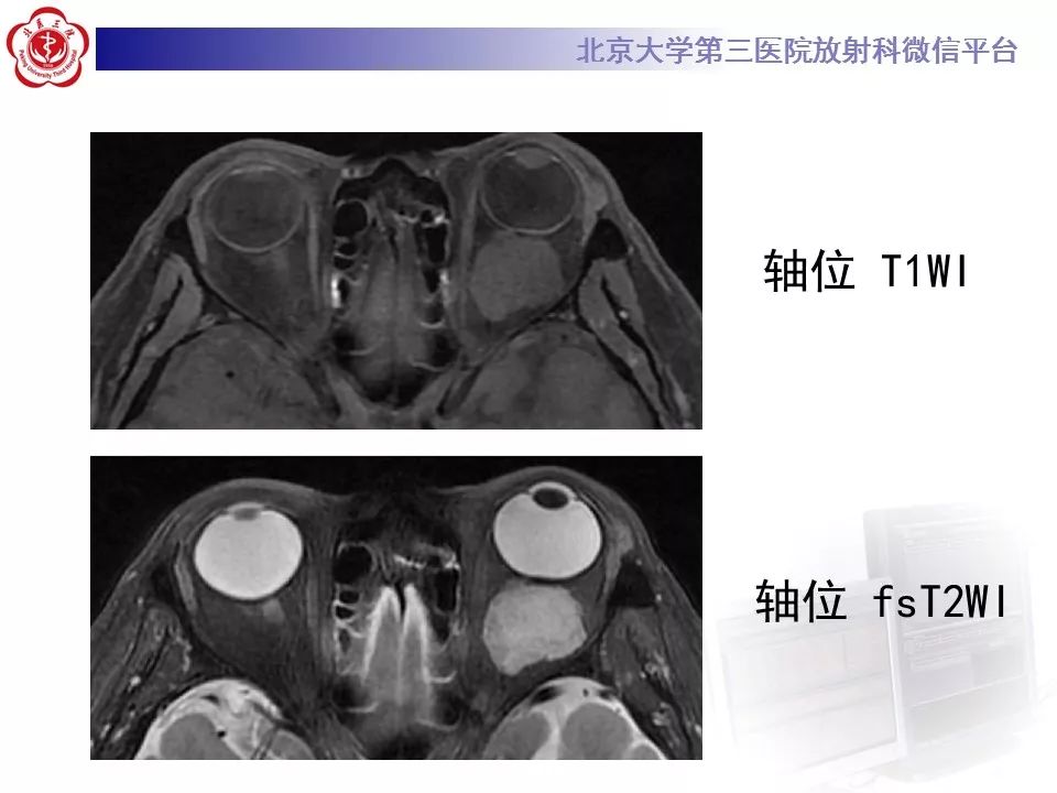 【病例】眼眶海绵状血管瘤1例CT及MR