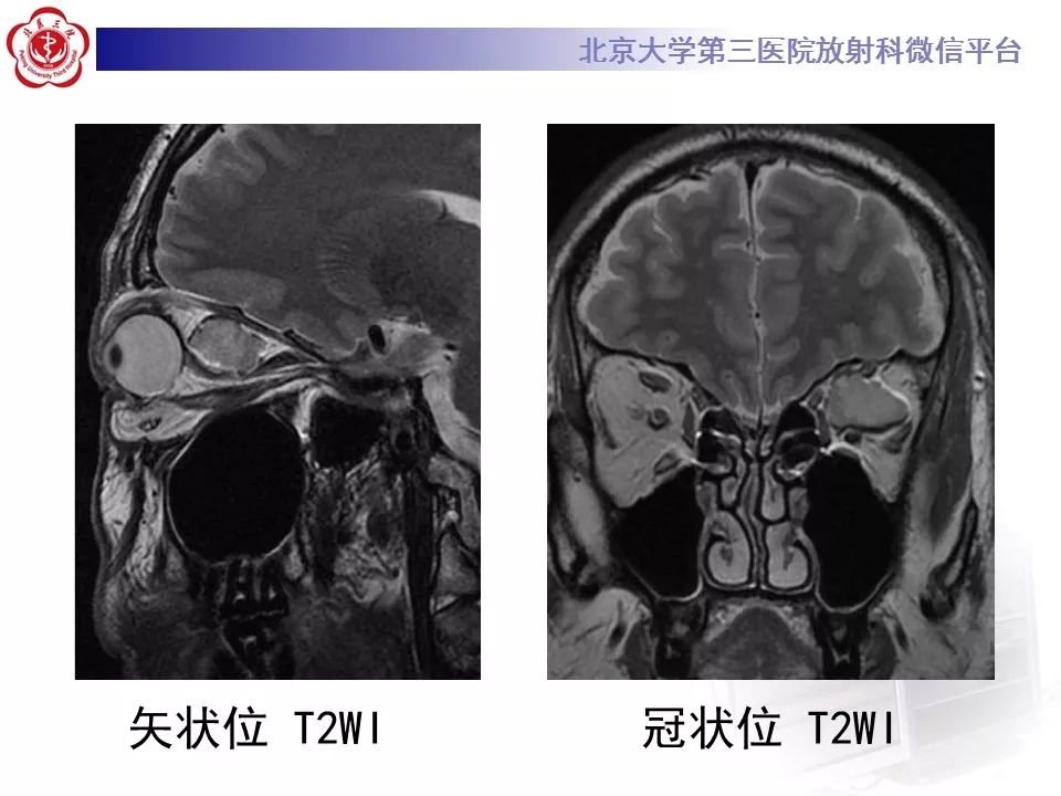 【病例】眼眶海绵状血管瘤1例CT及MR