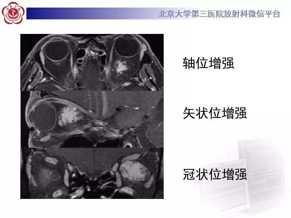 【病例】眼眶海绵状血管瘤1例CT及MR