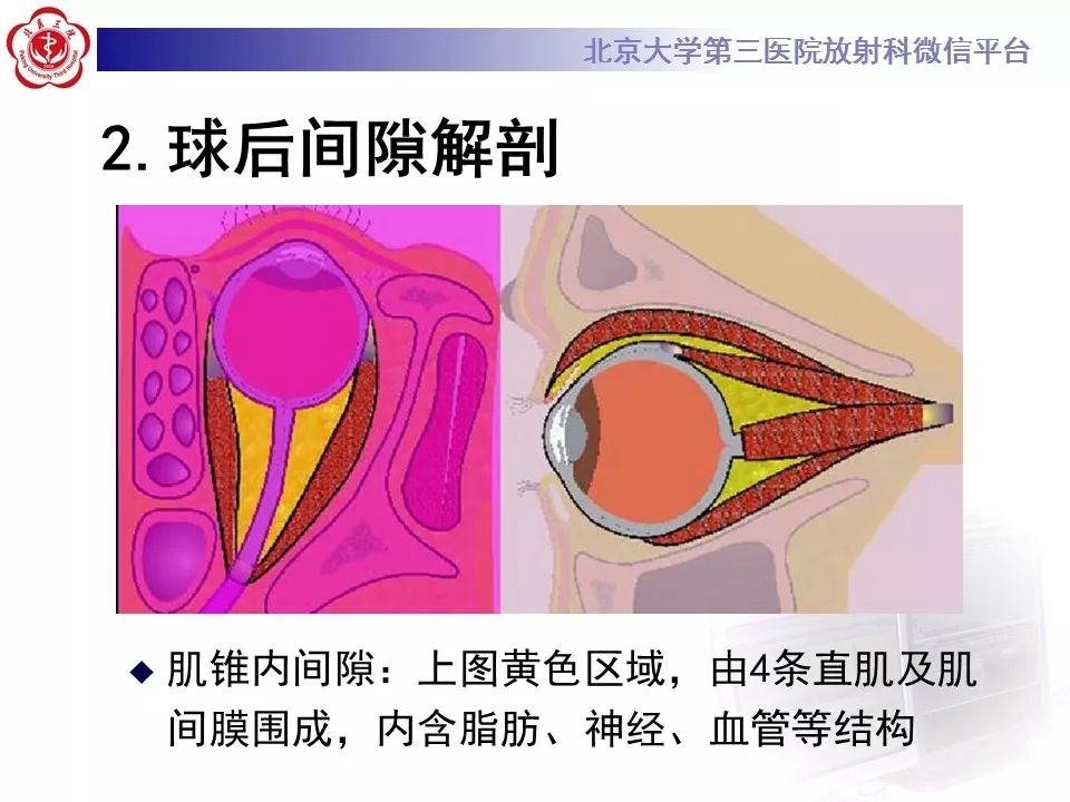 【病例】眼眶海绵状血管瘤1例CT及MR