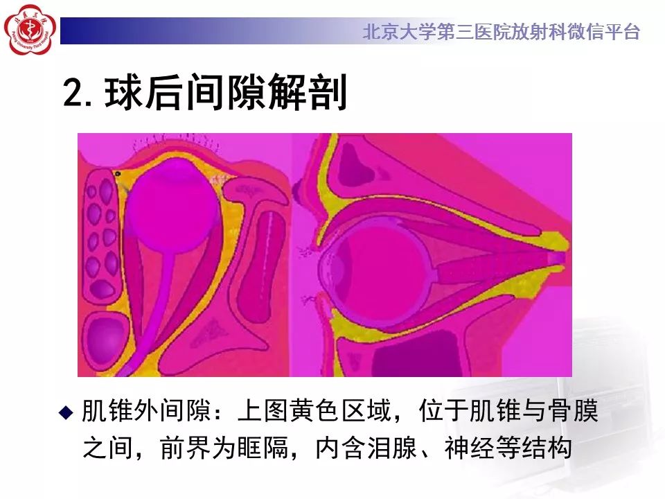 【病例】眼眶海绵状血管瘤1例CT及MR