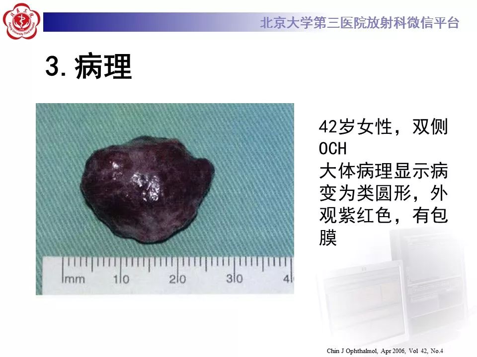 【病例】眼眶海绵状血管瘤1例CT及MR