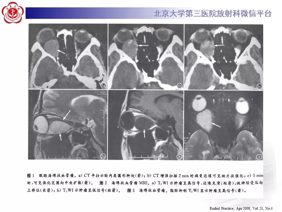 【病例】眼眶海绵状血管瘤1例CT及MR