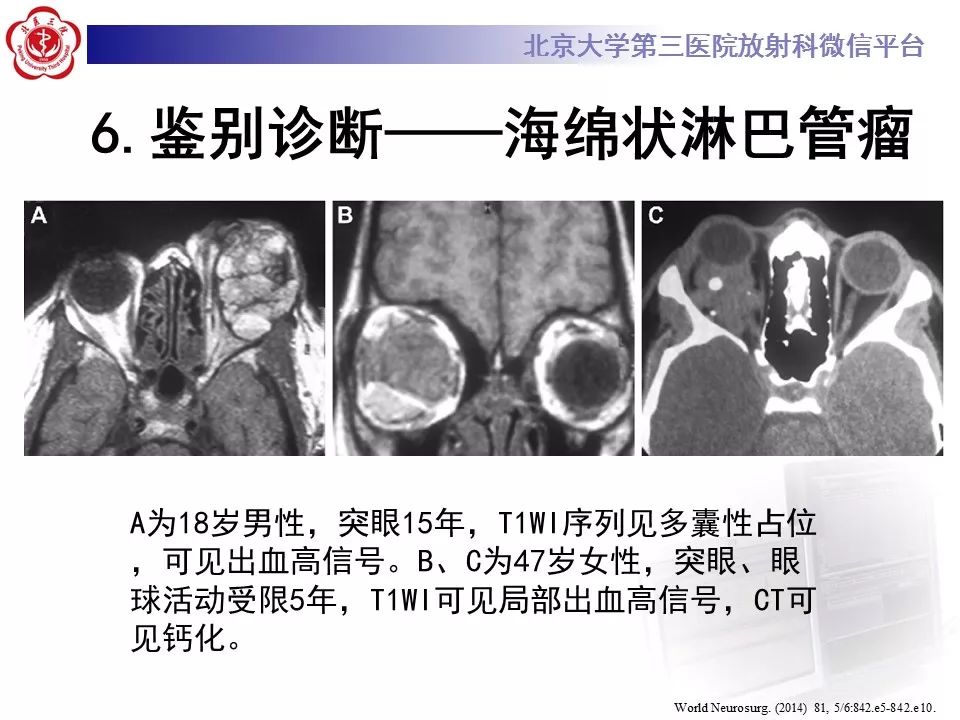 【病例】眼眶海绵状血管瘤1例CT及MR