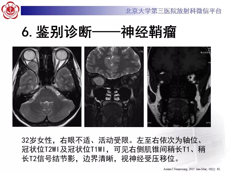 【病例】眼眶海绵状血管瘤1例CT及MR