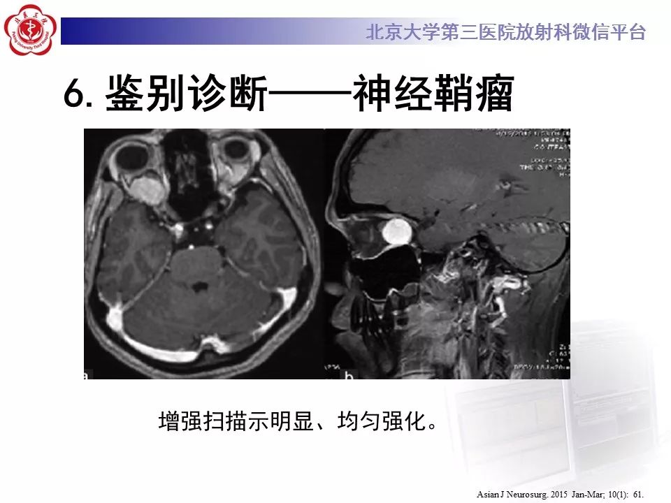 【病例】眼眶海绵状血管瘤1例CT及MR