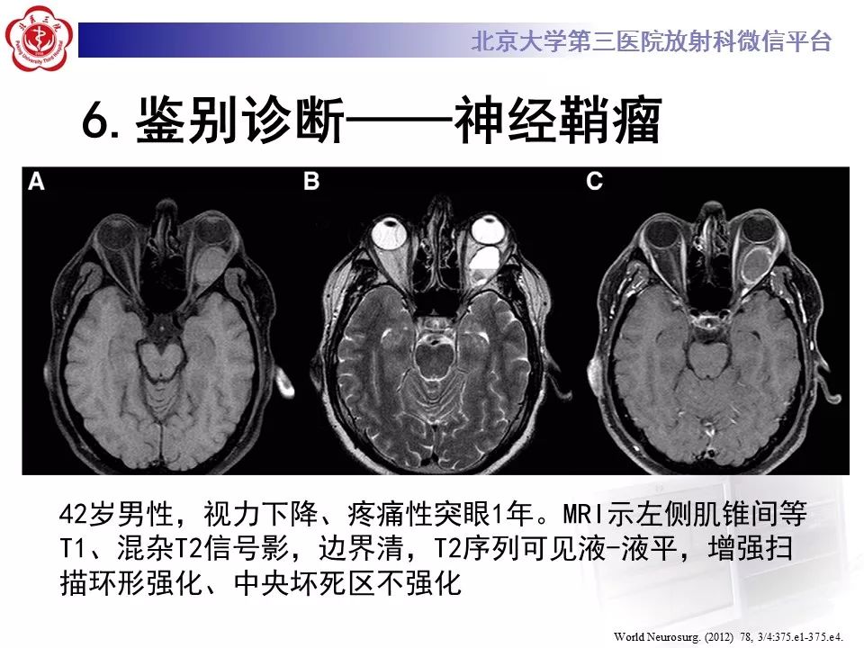 【病例】眼眶海绵状血管瘤1例CT及MR