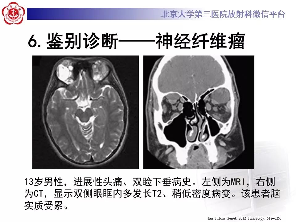 【病例】眼眶海绵状血管瘤1例CT及MR