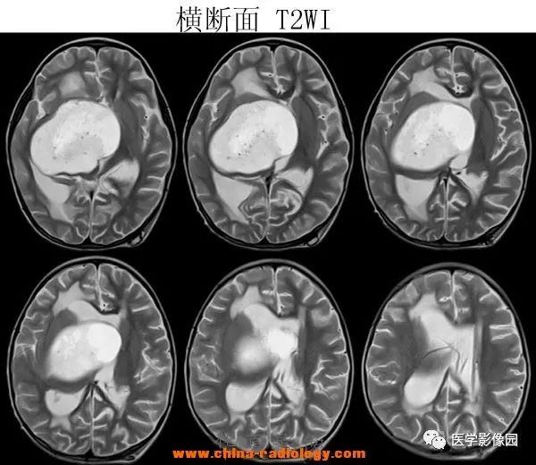 【病例】鞍区毛细胞型星形细胞瘤1例CT及MR 【病例】鞍区毛细胞型星形细胞瘤1例CT及MR