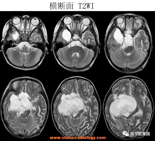 【病例】鞍区毛细胞型星形细胞瘤1例CT及MR 【病例】鞍区毛细胞型星形细胞瘤1例CT及MR