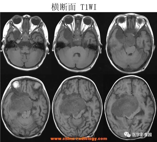 【病例】鞍区毛细胞型星形细胞瘤1例CT及MR 【病例】鞍区毛细胞型星形细胞瘤1例CT及MR