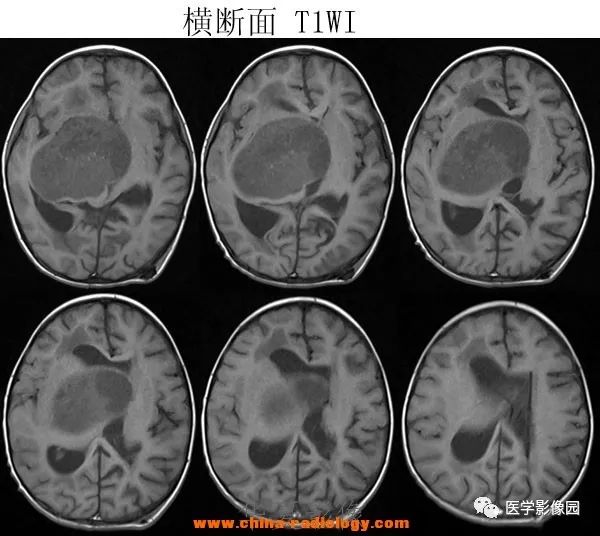 【病例】鞍区毛细胞型星形细胞瘤1例CT及MR 【病例】鞍区毛细胞型星形细胞瘤1例CT及MR