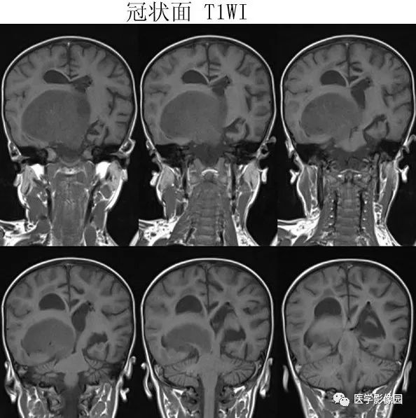 【病例】鞍区毛细胞型星形细胞瘤1例CT及MR 【病例】鞍区毛细胞型星形细胞瘤1例CT及MR